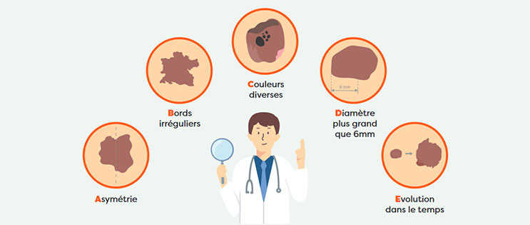 Infographie Mélanome ABCDE Infographie Mélanome ABCDE