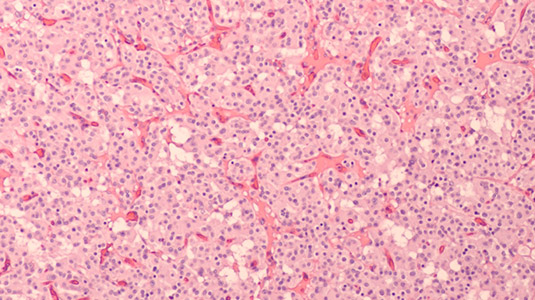 Tumeurs neuroendocrines